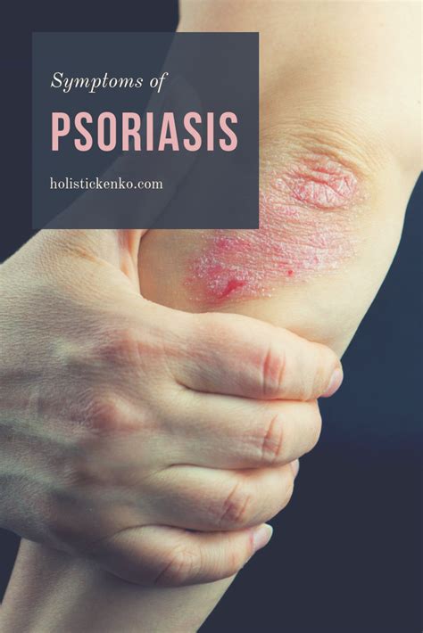 Pin on Skin Disorders and Psoriasis