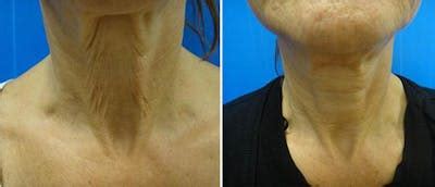 Laser Skin Tightening Before & After Photos | CosmetiCare