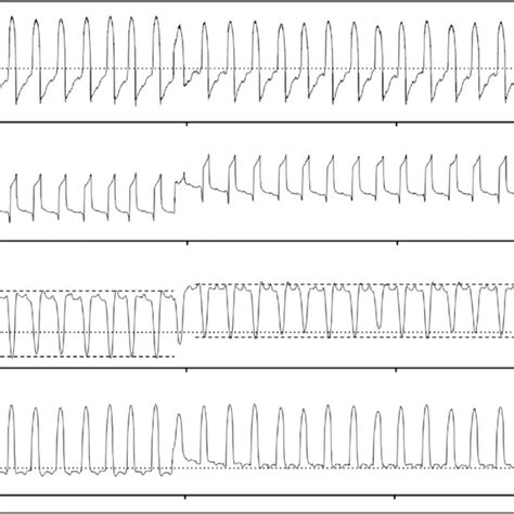 Lower PEEP in severe ARDS presents more lung collapse, resulting in ...