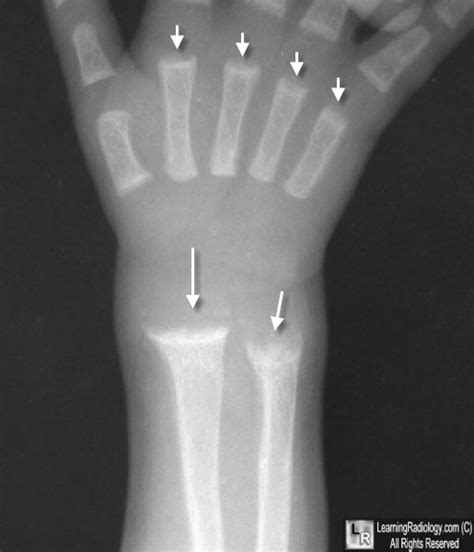 Rickets Disease X Rays