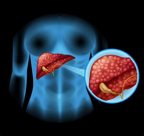 Gallbladder Stones Treatment at Home: Ayurvedic Treatment