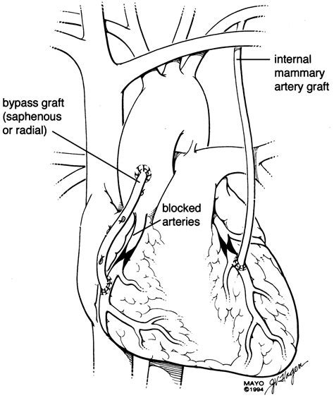 Coronary Artery Bypass Graft