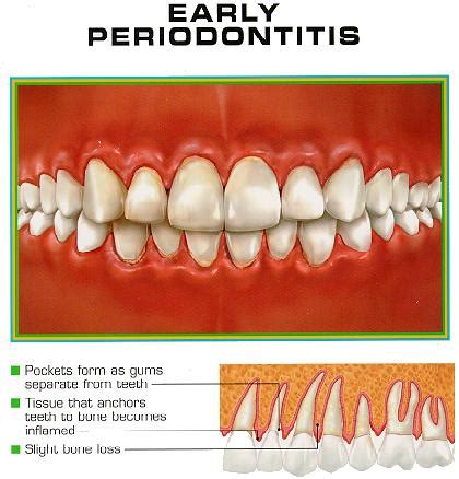 Aggressive periodontitis | Intelligent Dental