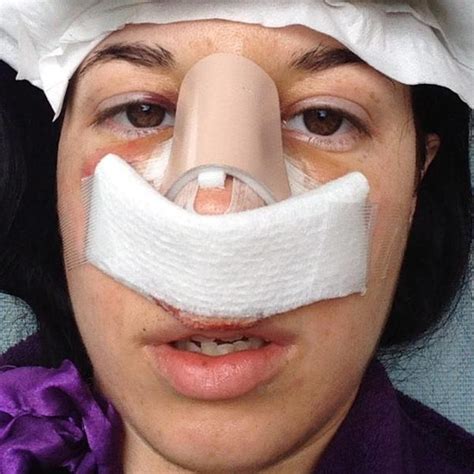 Correcting A Deviated Septum With Surgery Photos » Rhinoplasty: Cost, Pics, Reviews, Q&A