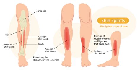 Preventing and Treating Shin Splints | Sterosport