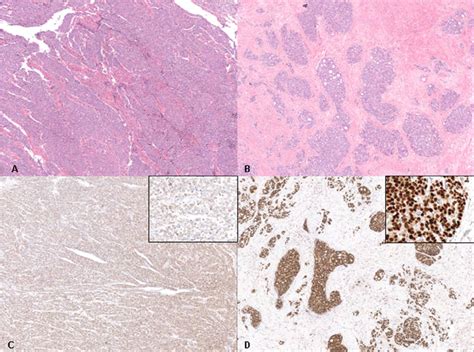 Images from case 12 showing high-grade urothelial carcinoma (A and C)... | Download Scientific ...