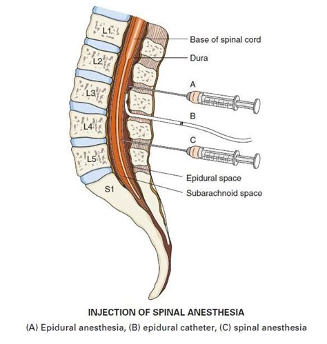 Spinal Anesthesia | Nurse anesthetist, Anesthesia school, Nurse anesthesia