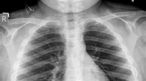 Air trapping in the left lung in the chest x-ray image. | Download ...