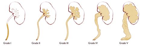 Vesicoureteral Reflux - Children's Hospital of Orange County