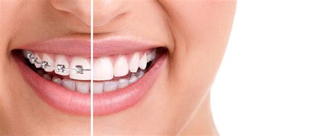 Health Benefits of Invisalign | Dr. Jeff Turner-Premier Provider