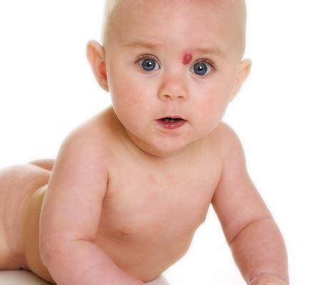 Birthmarks and baby spots - BabyScience