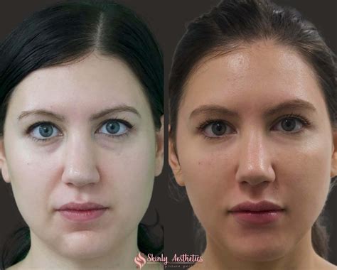 Non-Surgical Jawline Slimming with Botox | Skinly Aesthetics in NYC