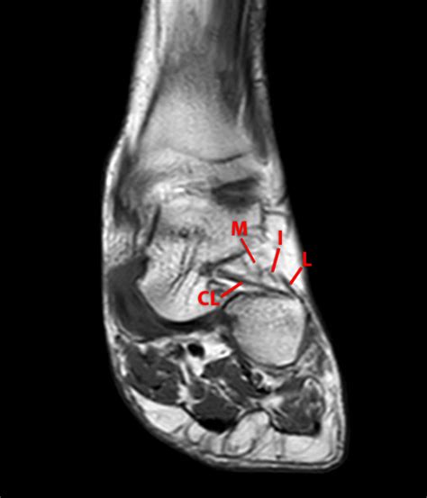 Sinus Tarsi Syndrome | Radsource