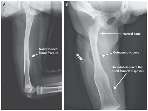 Osteopetrosis and Erlenmeyer-Flask Deformity | NEJM