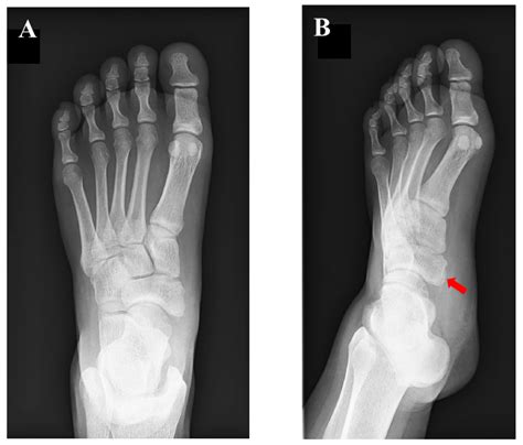 Medicina | Free Full-Text | Is the Small Ossicle of Type 1 Accessory ...