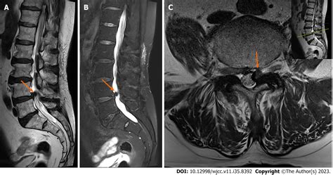 Ankle and toe weakness caused by calcified ligamentum flavum cyst: A case report