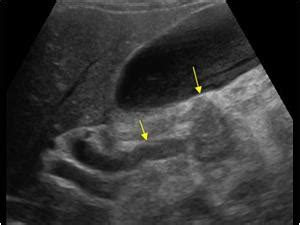 Abdomen and retroperitoneum | 1.3 Pancreas : Case 1.3.1 Pancreatic head ...