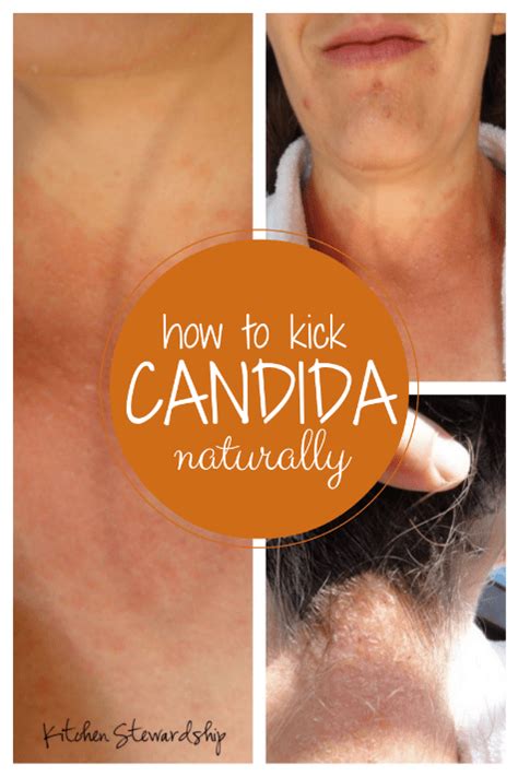 Candida Symptoms: Naturopath vs. M.D. about the Surprise Rash