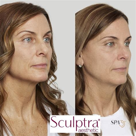 Dermal Fillers in Boise, Idaho | Sculptra — Spa 35