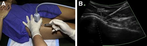 Ultrasound-Guided Intra-Articular Injection of the Hip: The Nashville ...