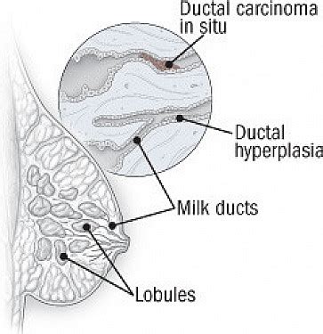 Invasive Ductal Carcinoma Diagram