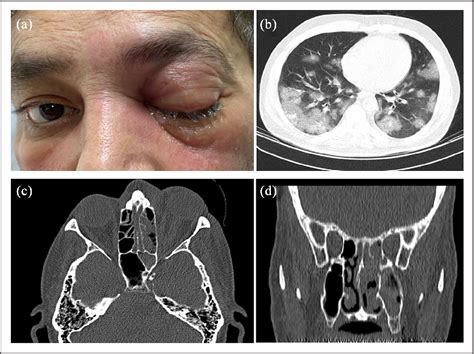 Figure 3 from Rhino-orbital mucormycosis during steroid therapy in COVID-19 patients: A case ...