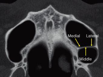 A Periodontal Expert: Maxillary Sinus Septa