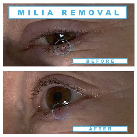 Milia removal treatments in Birmingham | Milia eyelid & eyelash | Milia face