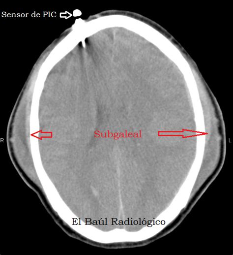 CEPHALOHEMATOMA VS SUBGALEAL HEMATOMA ULTRASOUND - Wroc?awski Informator Internetowy - Wroc?aw ...