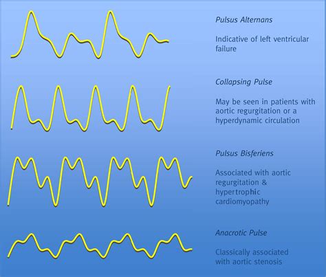 Monitoring central venous pressure, arterial pressure and pulmonary wedge pressure - Anaesthesia ...