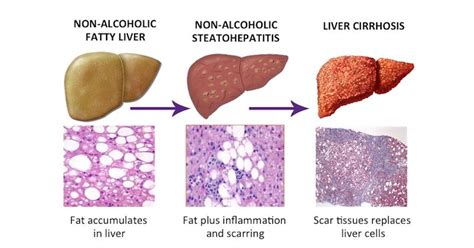 Liver enzymes count in your blood test results and what they mean what ...