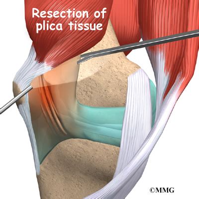 Plica Syndrome | eOrthopod.com