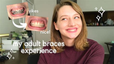 Braces Under Bite Adult Before And After