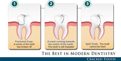 Cracked Tooth Syndrome – Dentist Downers Grove | General & Cosmetic ...