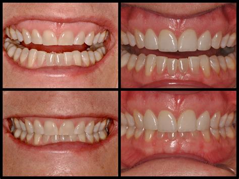 Smile Spotlight: Amy | Veneers Transform Teeth Grinding Damage