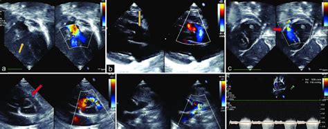 Echocardiogram in (a) apical five chamber view and (b) parasternal long ...