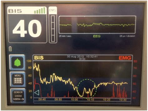 BiSpectral Index (BIS) monitoring may detect... | F1000Research