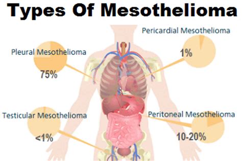 Mesothelioma cancer, causes, symptoms, diagnosis, prognosis & treatment