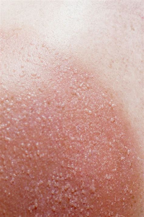 Sunburn treatment: How long does sunburn take to heal? | Express.co.uk