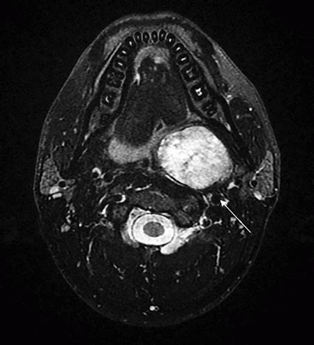 Soft Tissue Neck | Radiology Key