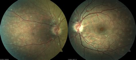 MEWDS (Multiple Evanescent White Dot Syndrome) - Retina Associates