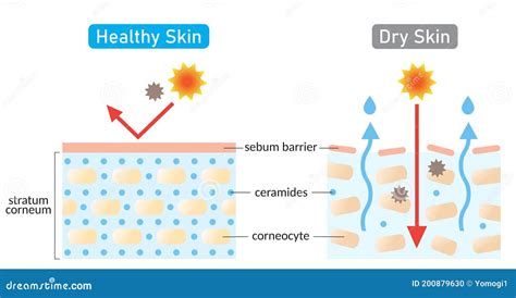 Dry and Healthy Skin Layer. Stratum Corneum and Ceramides. Illustration ...