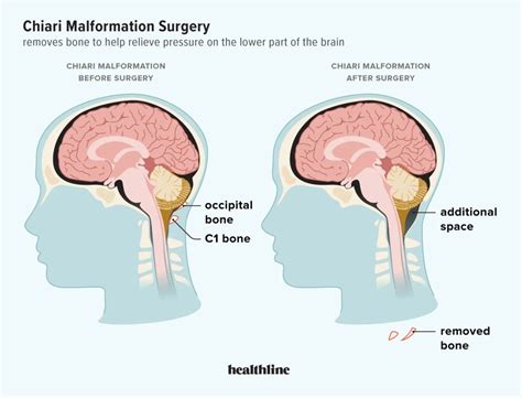 Chiari Malformation Surgery: Candidates, Procedure, Recovery, and More