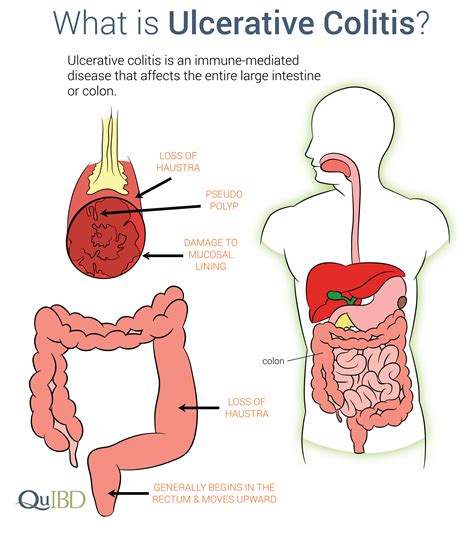 Ulcerative Colitis Symptoms IBD Prevalence Impact Causes