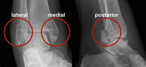 Cotton fracture • LITFL • Medical Eponym Library