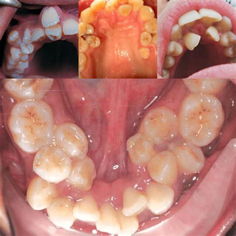 Hyperdontia - Condition that causes too many teeth to grow in your mouth : r/MakeMeSuffer