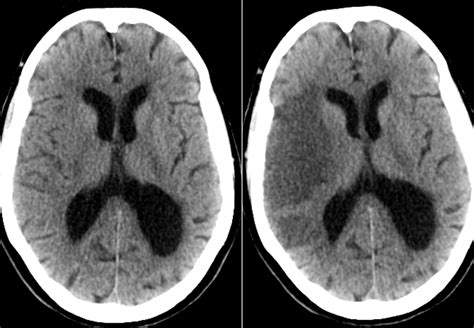 Infarction, middle cerebral artery; Cerebral Infarction, Middle ...