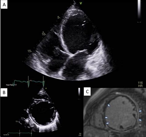 Dilated cardiomyopathy: the role of genetics, highlighted in a family ...