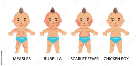 Infographics of childhood rash, measles, rubella, scarlet fever, varicella. Poster with a baby ...