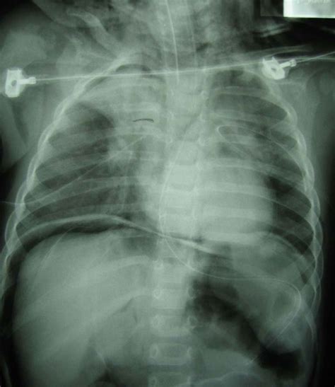 Iatrogenic tension pneumothorax in children: two case reports | Journal of Medical Case Reports ...